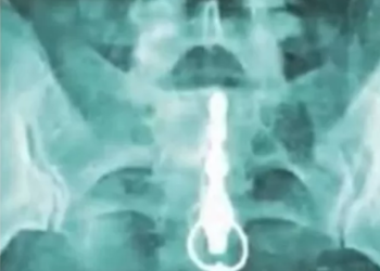 Americana é internada após vibrador ficar preso no reto: