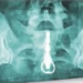 Americana é internada após vibrador ficar preso no reto: